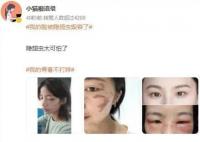 我的臉被隱翅蟲毀容了 不少網(wǎng)友曬出同款傷疤