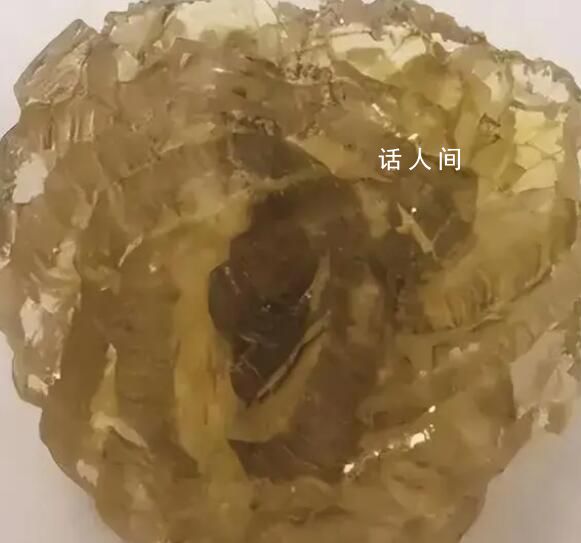 臺州女子身體里取出了“花” 晶瑩剔透酷似鉆石形如玫瑰