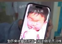 3歲男孩患象鼻病全球僅34例 且只在非洲國家發現