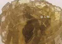 臺州女子身體里取出了“花” 晶瑩剔透酷似鉆石形如玫瑰