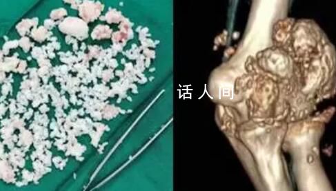 小伙熬夜打游戲關節(jié)長千顆白色顆粒 被診斷為滑膜軟骨瘤病