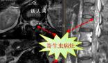 男子吞蛇膽喝蛇藥15年后發(fā)病 生吃蛇染寄生蟲