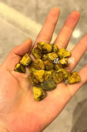 女生取24顆膽結(jié)石沒事盤著玩 21顆膽結(jié)石留在了手中
