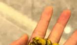 女生取24顆膽結石沒事盤著玩 21顆膽結石留在了手中